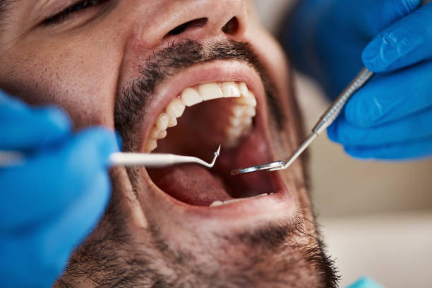 Best Emergency Root Canal Treatment in Key Center, WA